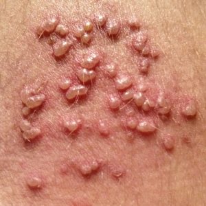 an example of shingles